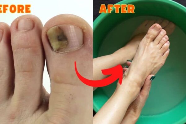 10 Effective & Natural Cure For Toenail Fungus