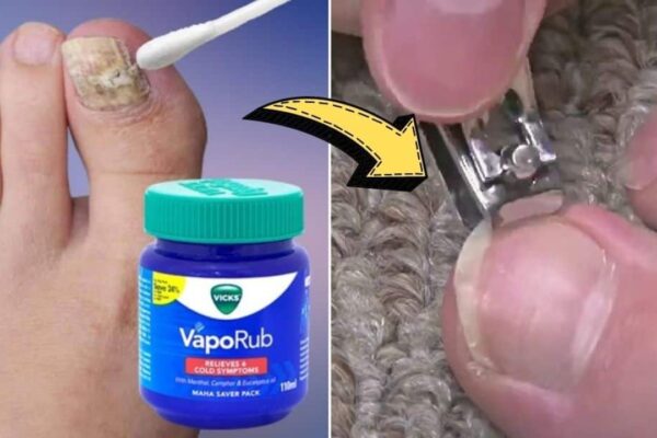 How To Treat Toenail Fungus With Vicks Vaporub
