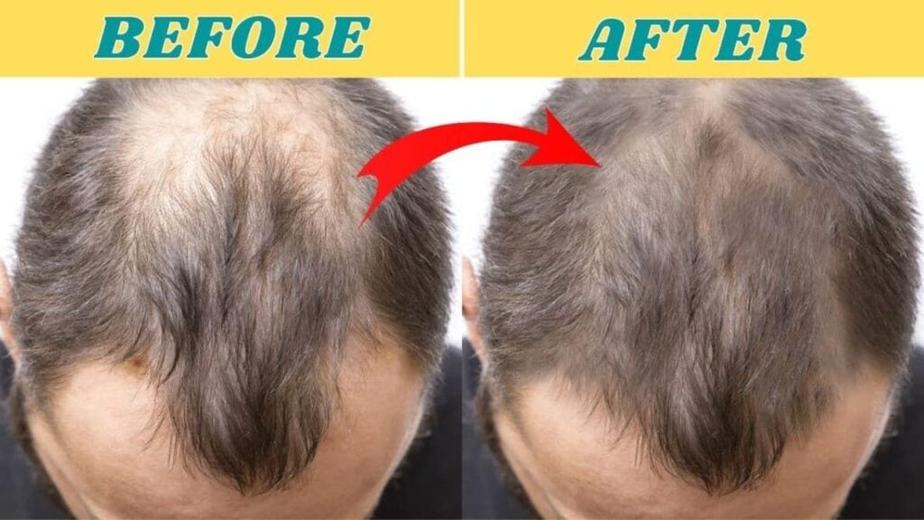 Finished 4 Home Remedies To Prevent Hair Loss & Regrow Your Hair, a completed DIY project