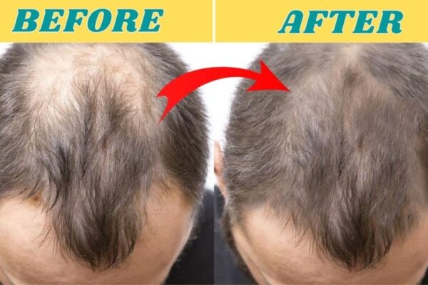 Finished 4 Home Remedies To Prevent Hair Loss & Regrow Your Hair, a completed DIY project