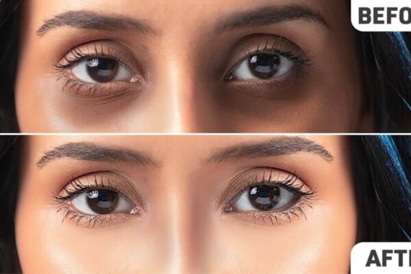 How to Remove Dark Circles Under Your Eyes